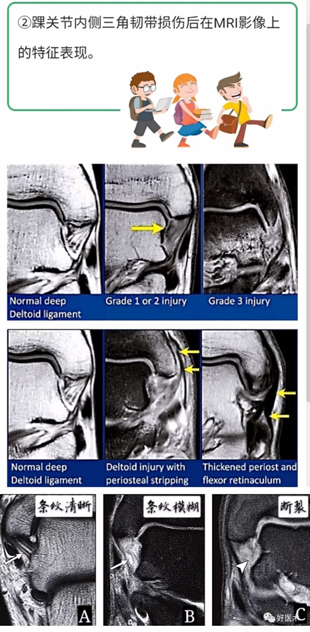 一文搞定！踝关节周围韧带的解剖及MRI特征