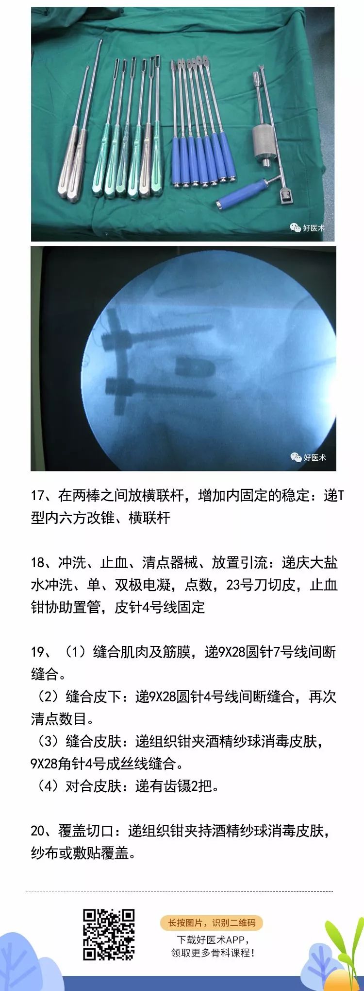 腰椎椎弓根内固定+椎间融合术，手术技巧全解析！