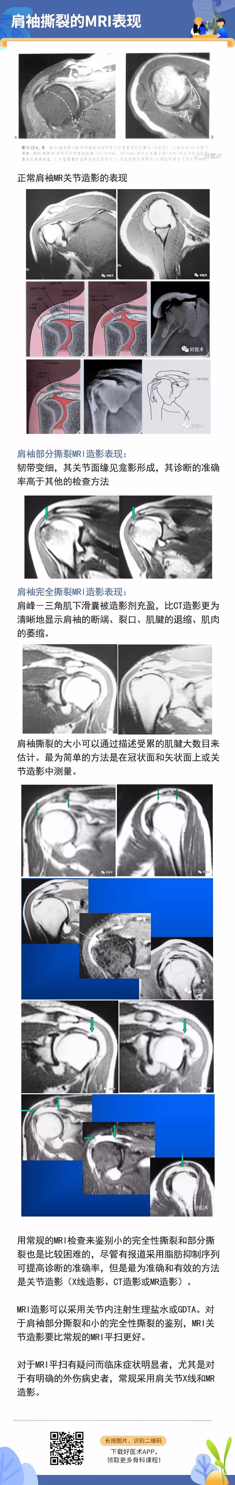 干货来了！一文掌握肩袖损伤MRI诊断技巧