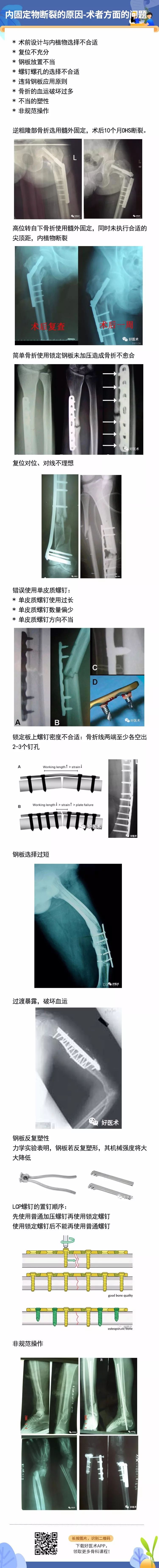 骨科内固定物断裂的原因，4张图就说明了！