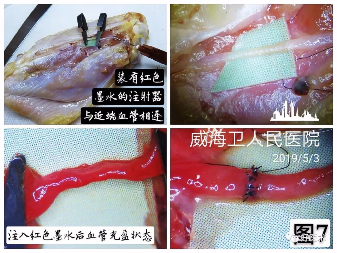 显微血管吻合技术要点详解，值得一看！