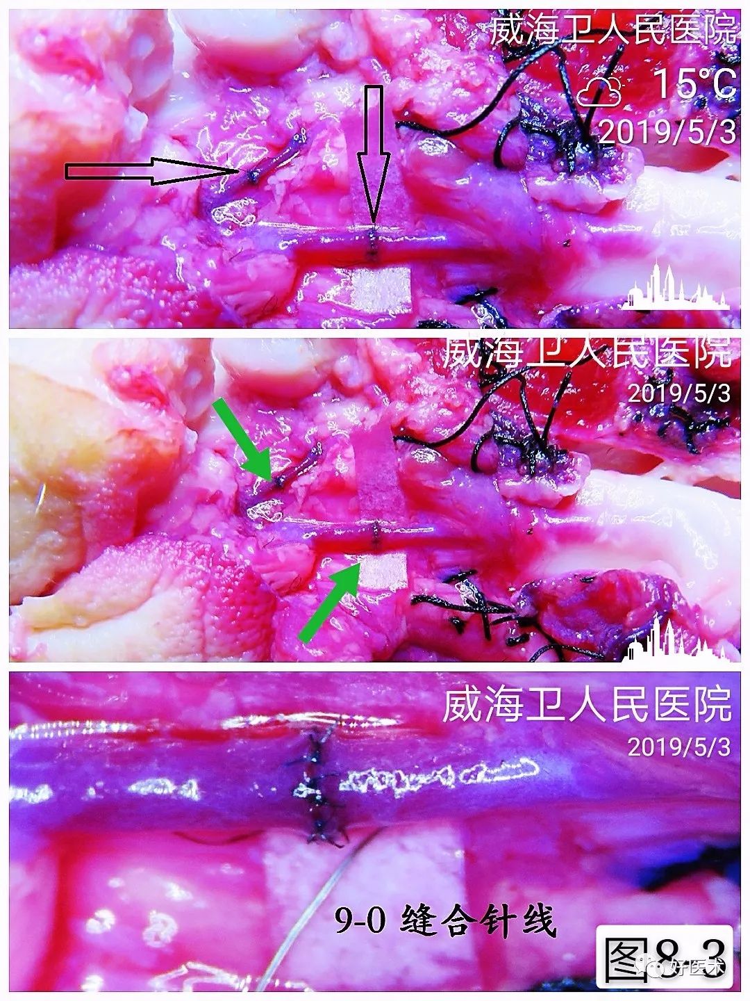 显微血管吻合技术要点详解，值得一看！