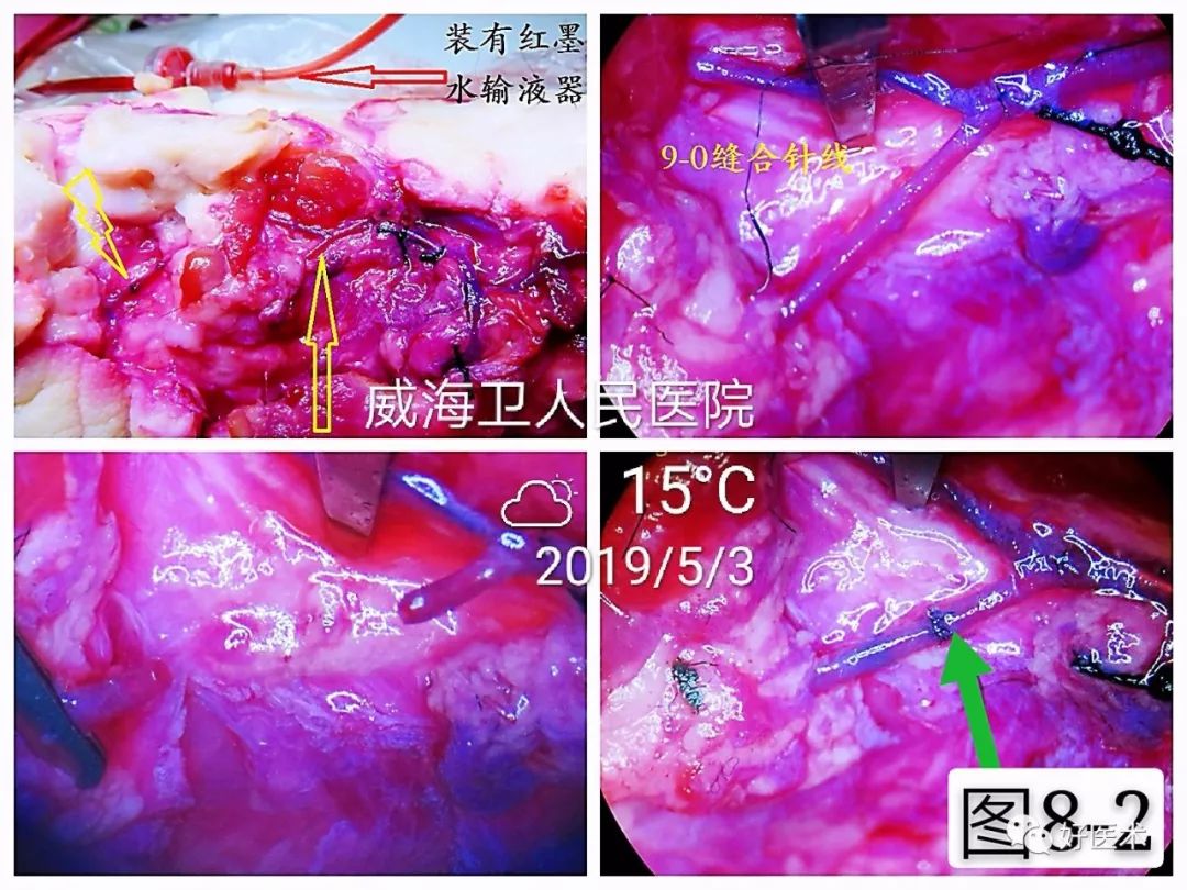 显微血管吻合技术要点详解，值得一看！