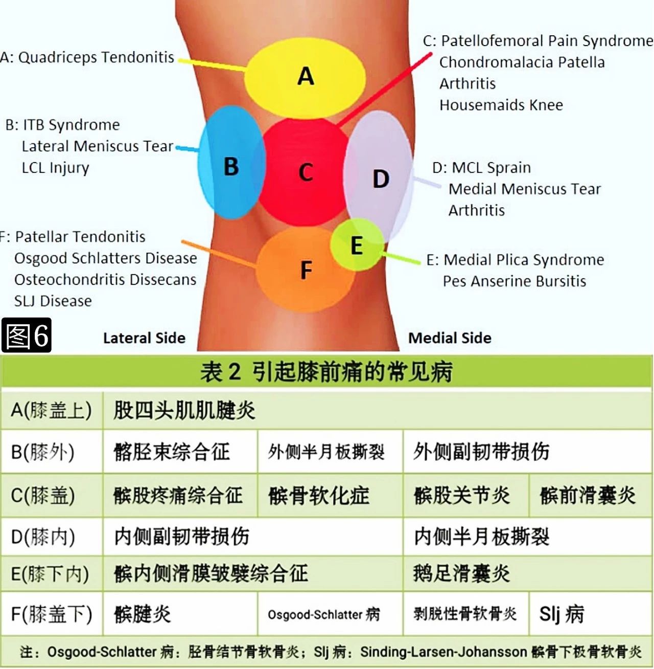 引起青壮年膝前痛的髌骨软骨软化症，你了解吗？