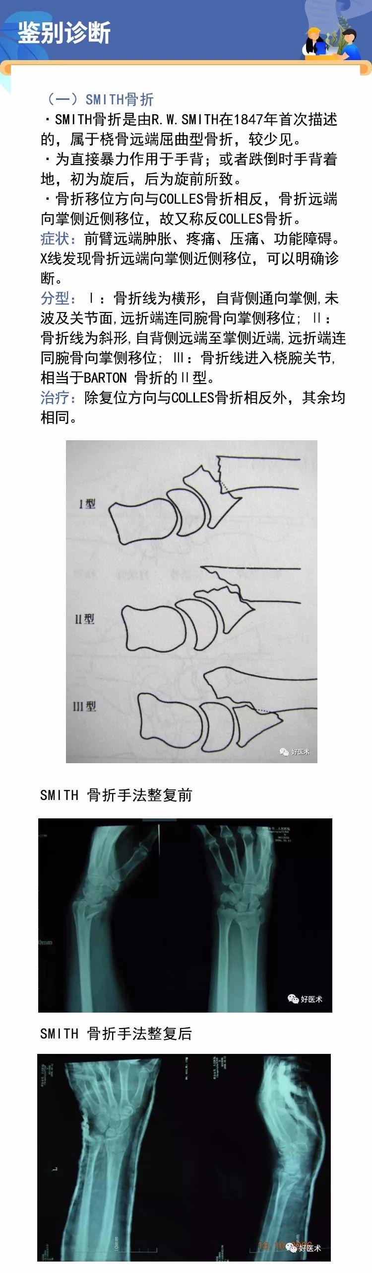 关于Colles骨折，这篇文章讲得太全面了！