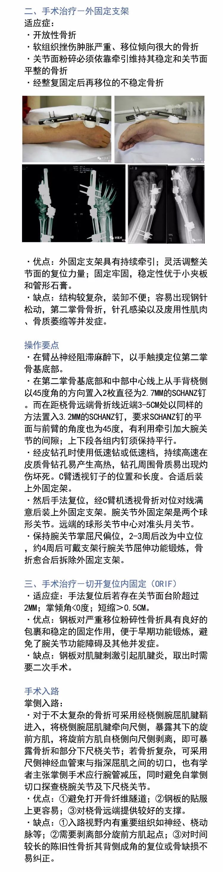 关于Colles骨折，这篇文章讲得太全面了！