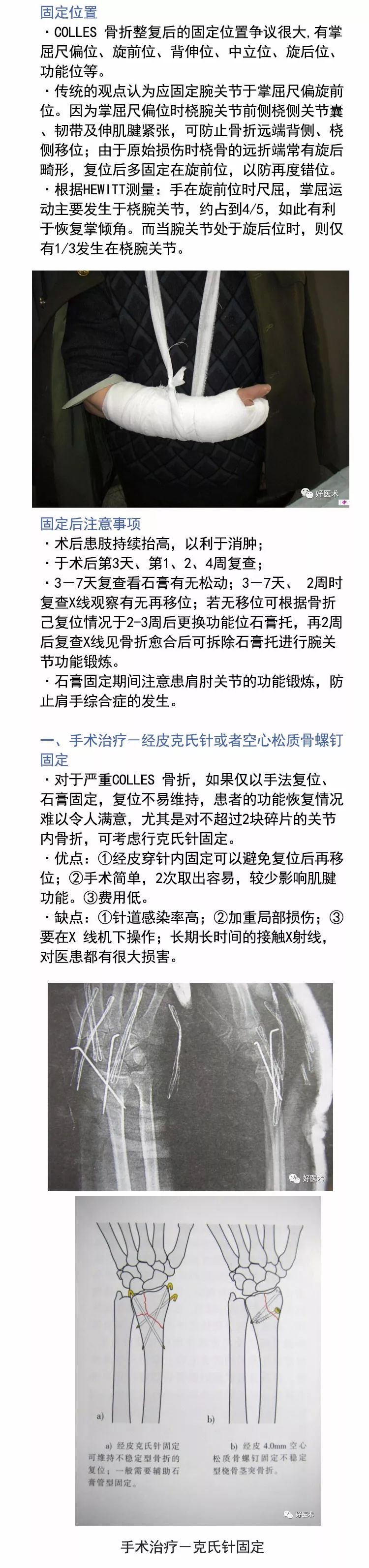 关于Colles骨折，这篇文章讲得太全面了！