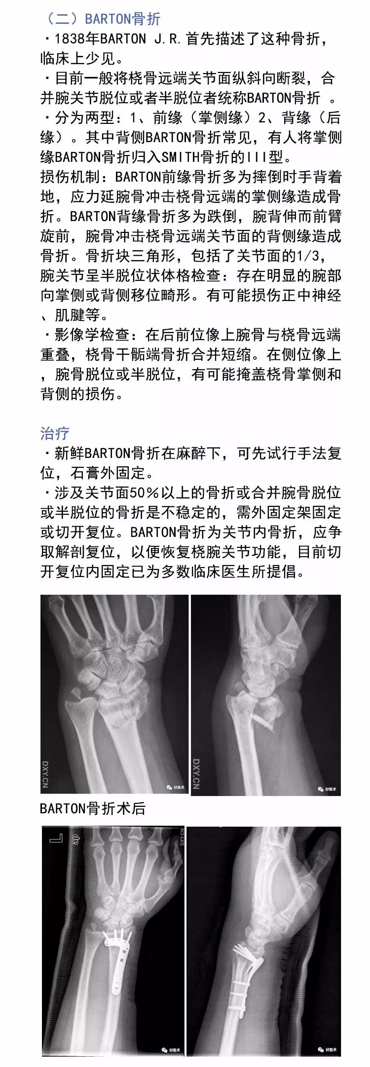 关于Colles骨折，这篇文章讲得太全面了！