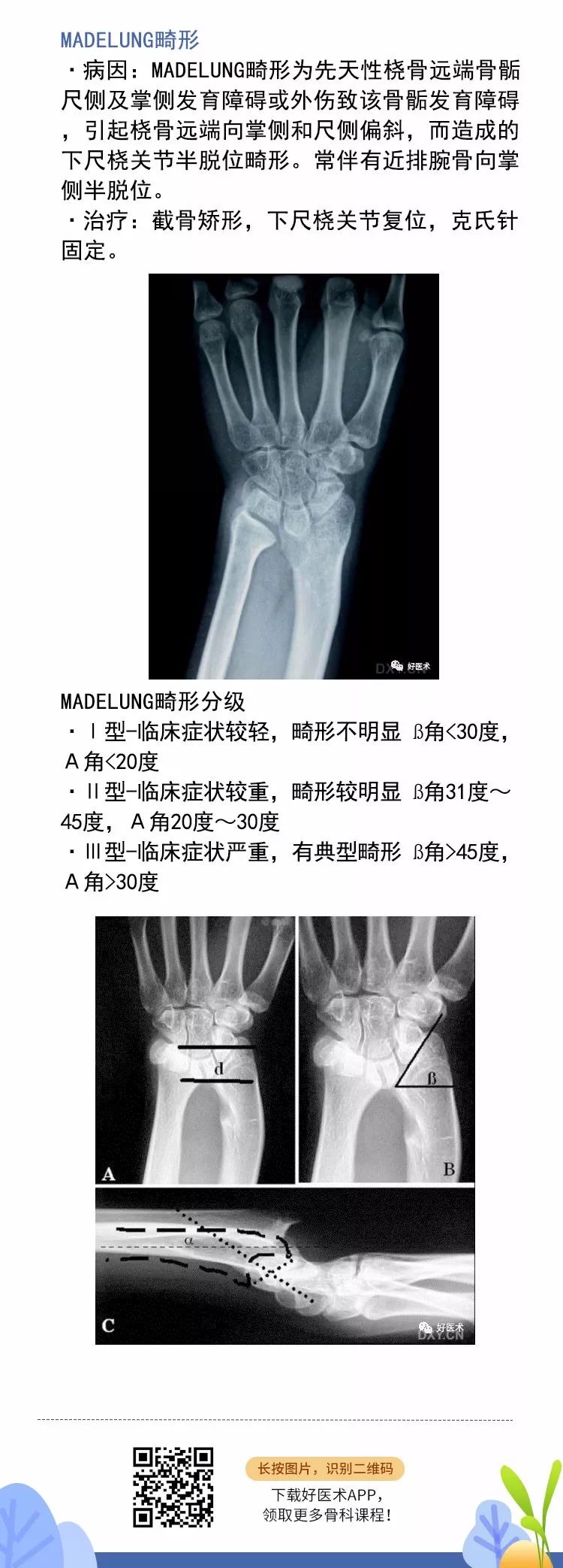 关于Colles骨折，这篇文章讲得太全面了！