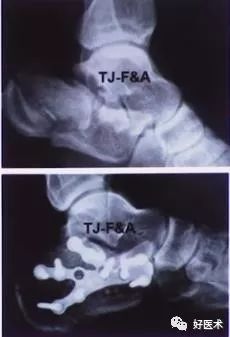 跟骨骨折如何选择手术入路及内固定？看看这篇！
