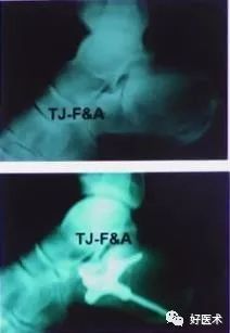 跟骨骨折如何选择手术入路及内固定？看看这篇！
