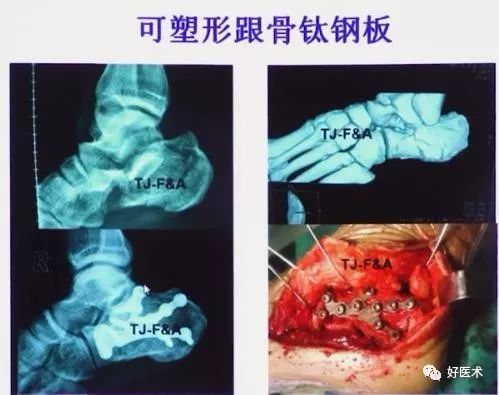 跟骨骨折如何选择手术入路及内固定？看看这篇！