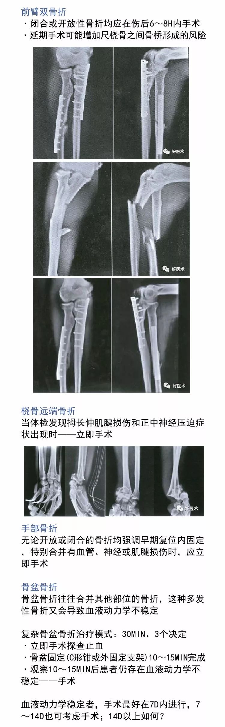 值得收藏！各部位骨折手术时机的选择