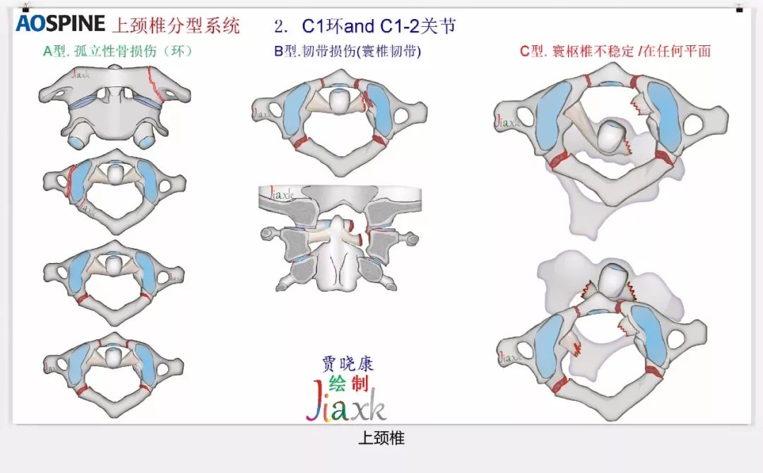 值得收藏！最全的AO骨折分型图谱