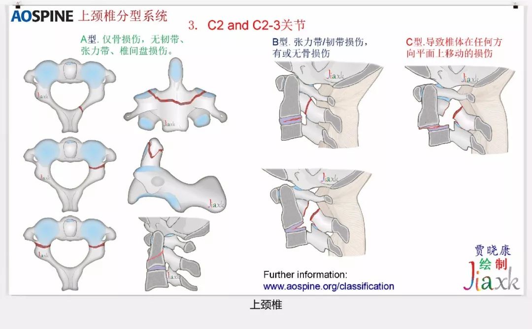 值得收藏！最全的AO骨折分型图谱