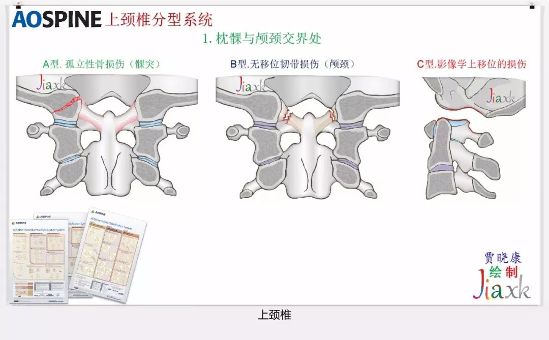 值得收藏！最全的AO骨折分型图谱