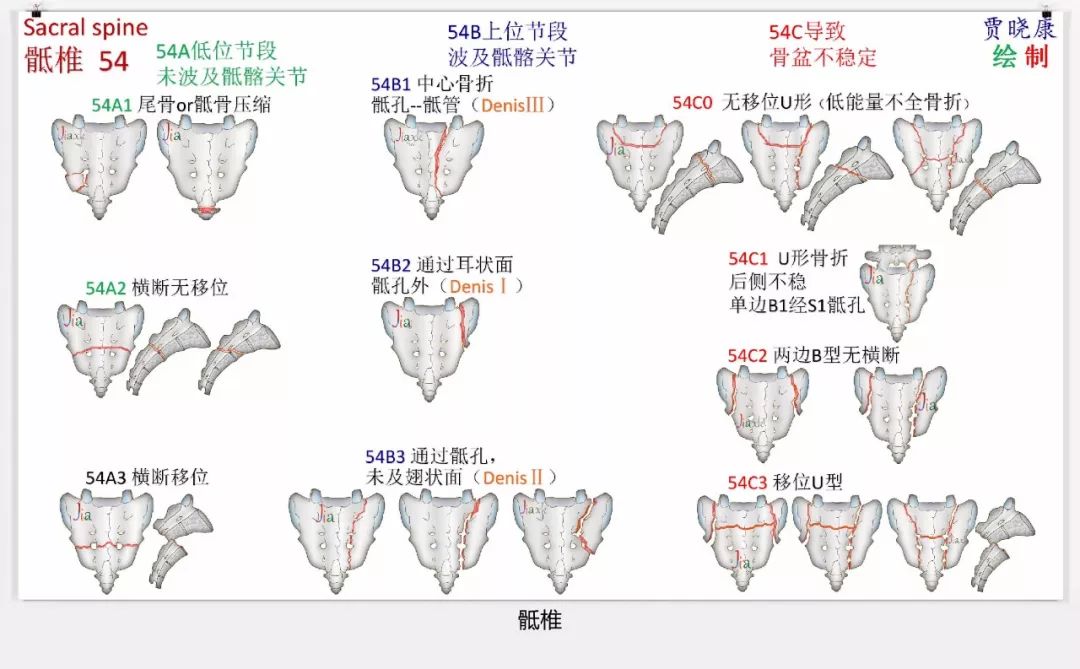 值得收藏！最全的AO骨折分型图谱