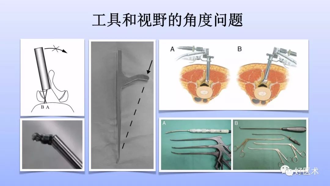 一文带您深度了解：腰椎管狭窄症！