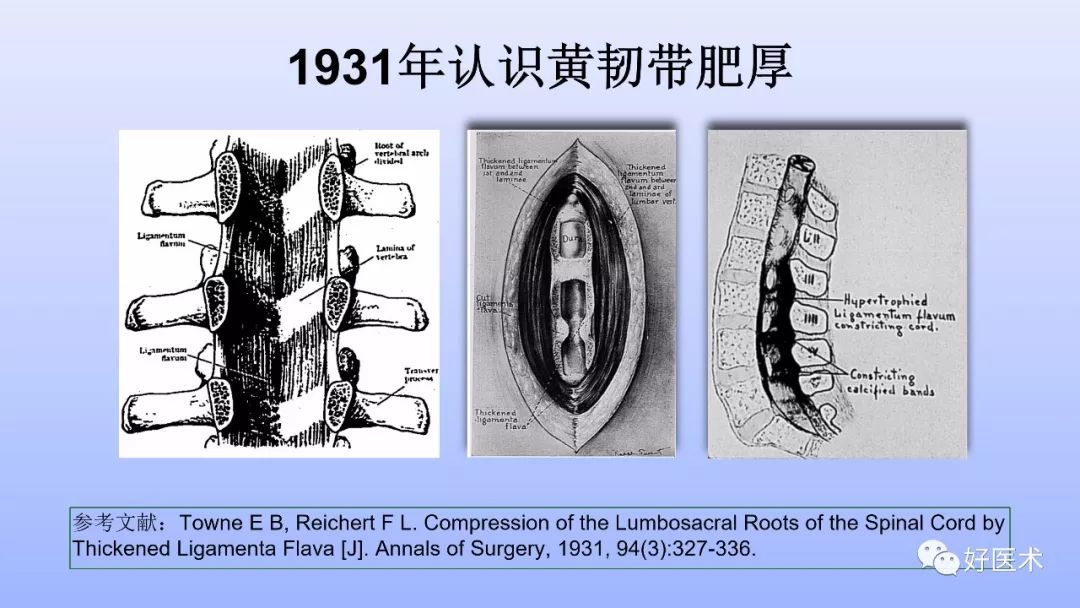 一文带您深度了解：腰椎管狭窄症！