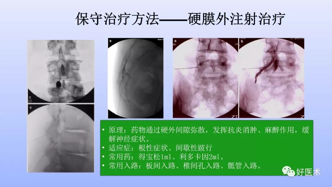 一文带您深度了解：腰椎管狭窄症！