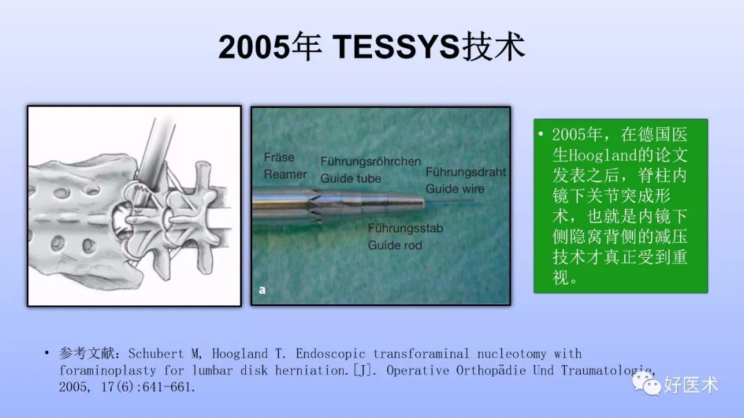 一文带您深度了解：腰椎管狭窄症！