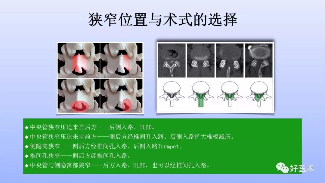 一文带您深度了解：腰椎管狭窄症！