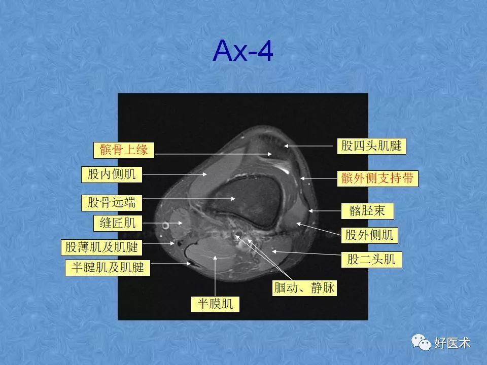 膝关节MRI高清解剖图解，值得收藏！