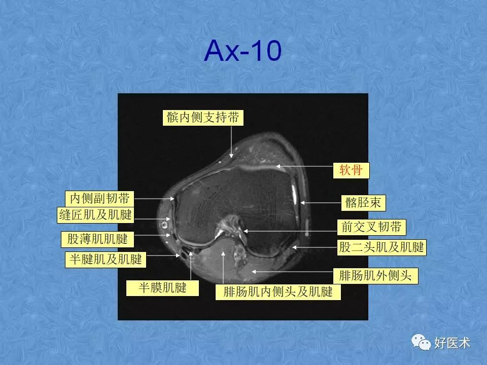 膝关节MRI高清解剖图解，值得收藏！