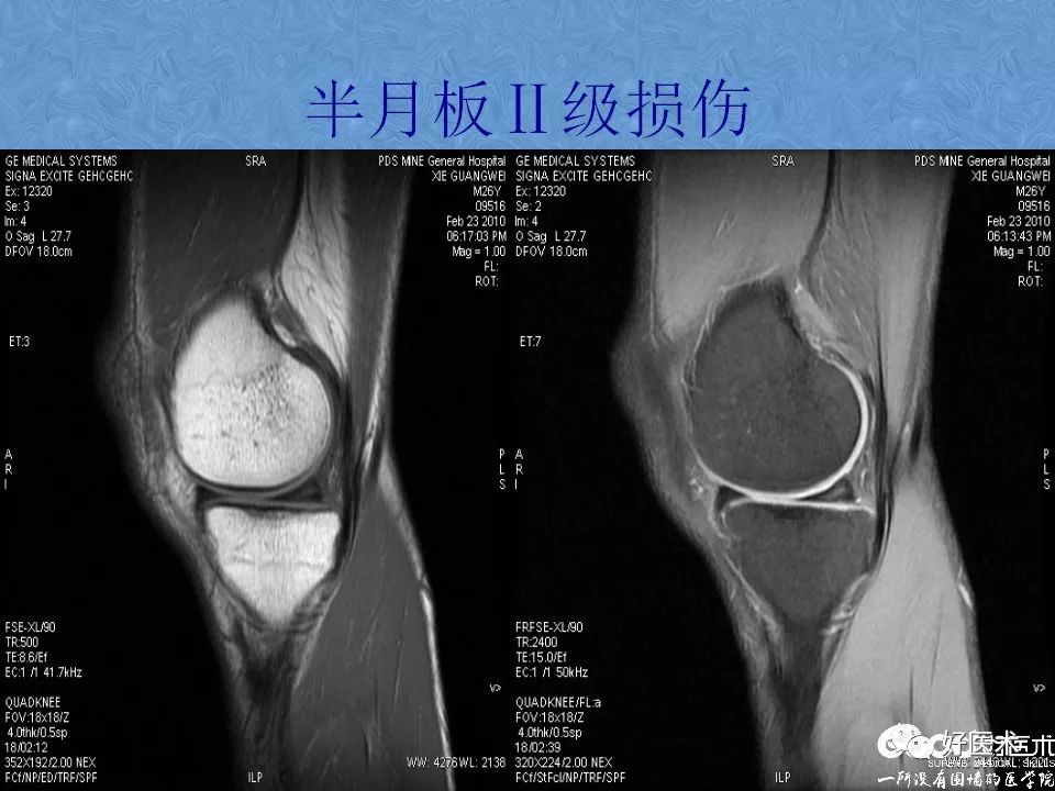 膝关节MRI高清解剖图解，值得收藏！