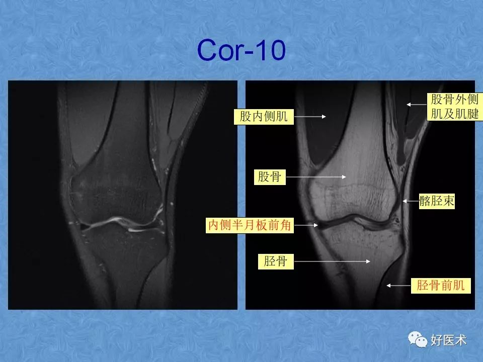 膝关节MRI高清解剖图解，值得收藏！