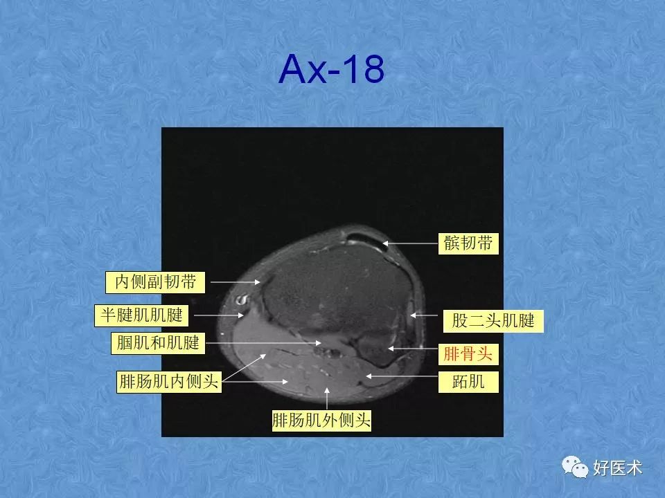 膝关节MRI高清解剖图解，值得收藏！