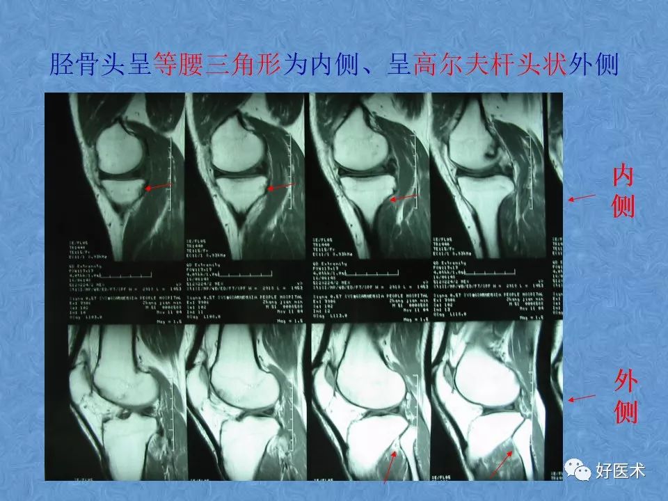 膝关节MRI高清解剖图解，值得收藏！