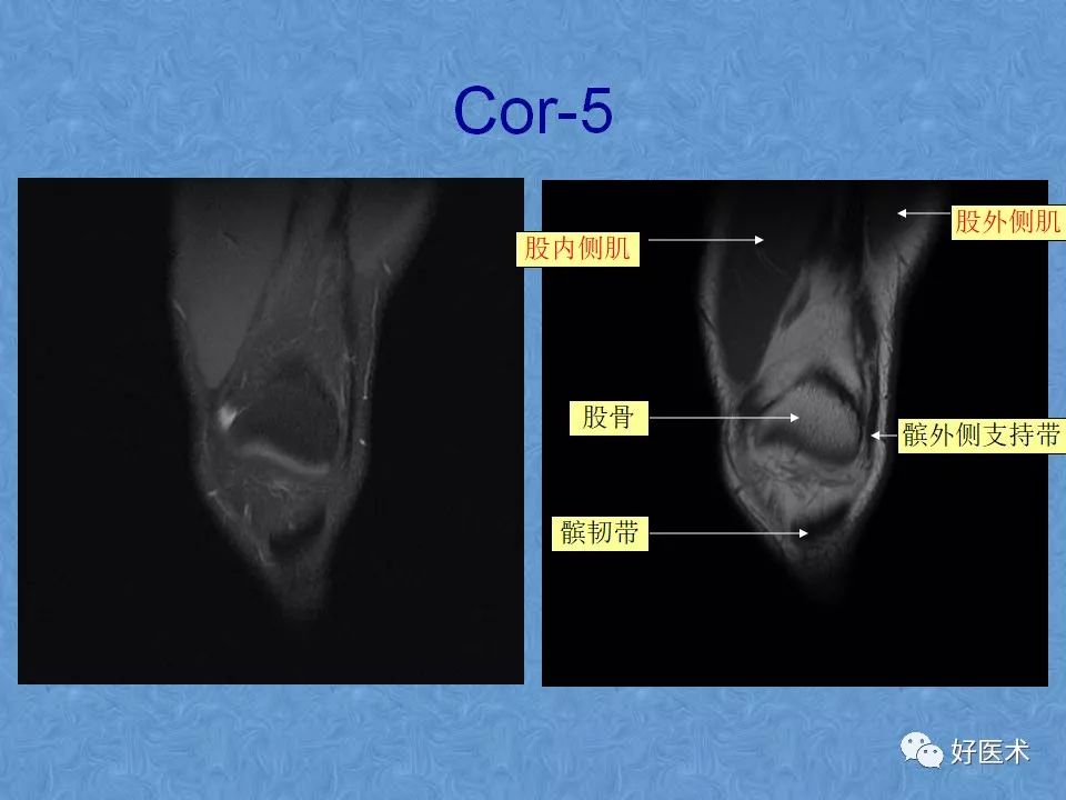 膝关节MRI高清解剖图解，值得收藏！