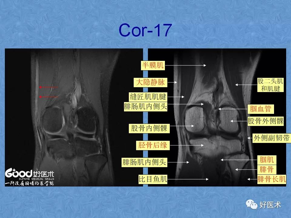 膝关节MRI高清解剖图解，值得收藏！