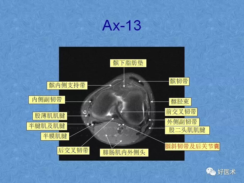 膝关节MRI高清解剖图解，值得收藏！