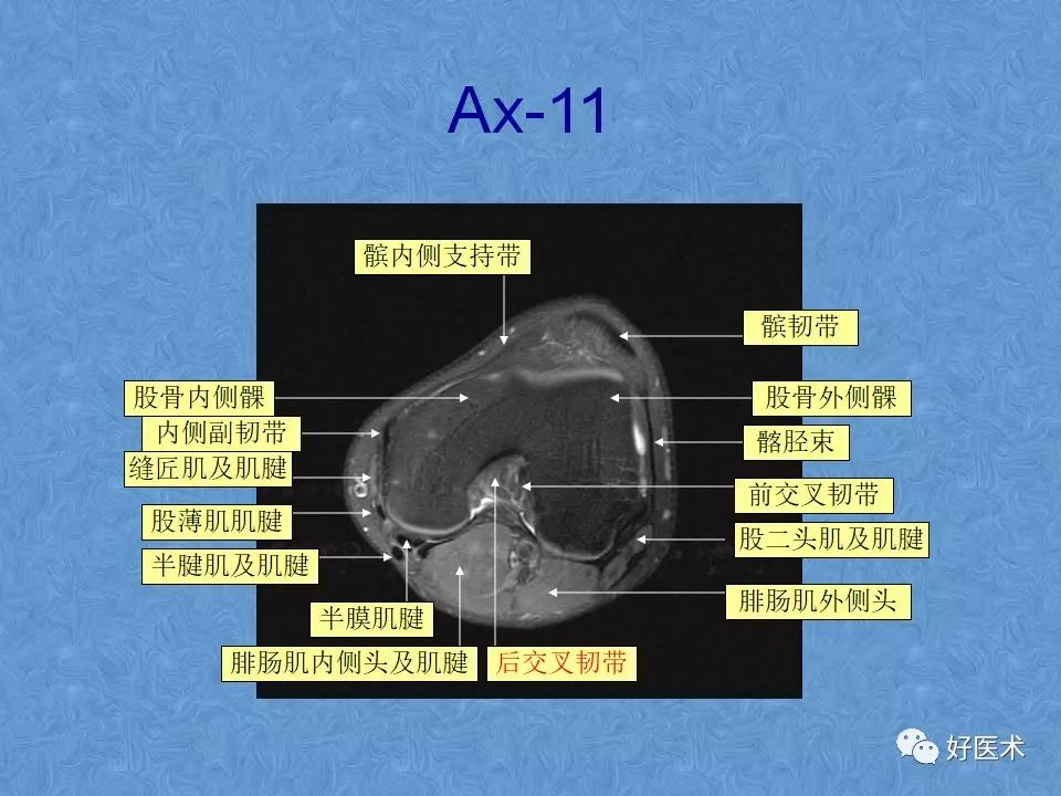 膝关节MRI高清解剖图解，值得收藏！