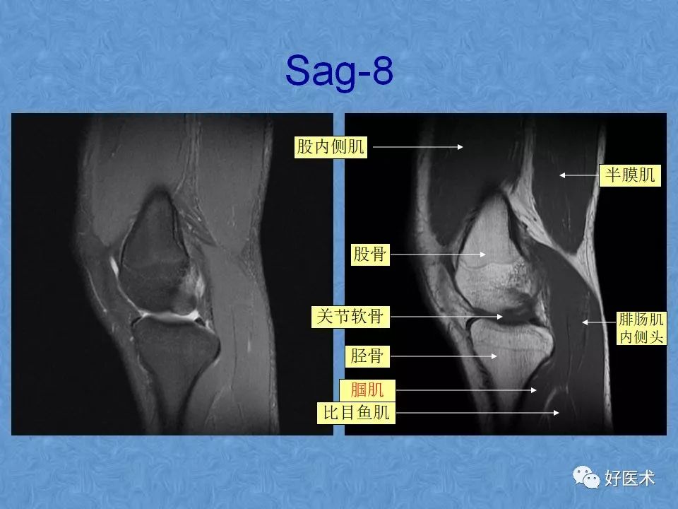 膝关节MRI高清解剖图解，值得收藏！
