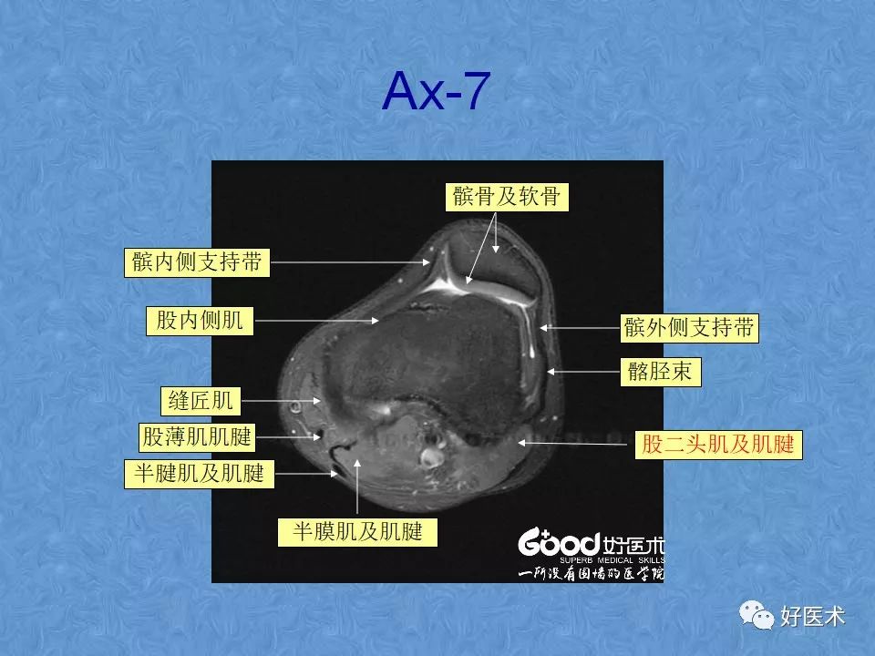 膝关节MRI高清解剖图解，值得收藏！