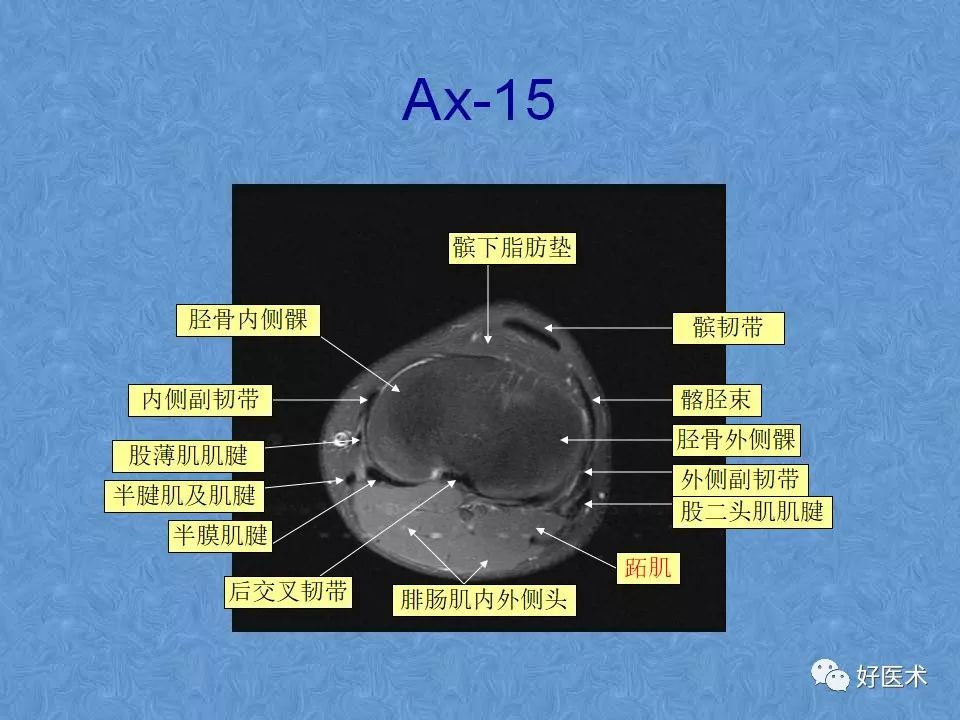 膝关节MRI高清解剖图解，值得收藏！