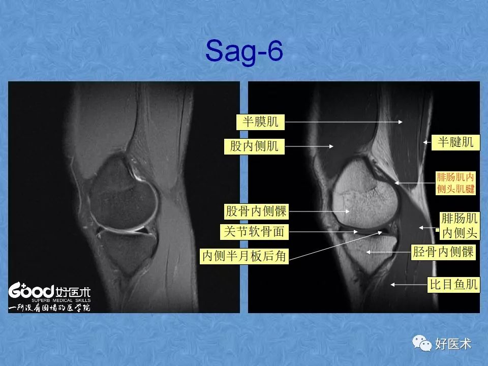 膝关节MRI高清解剖图解，值得收藏！