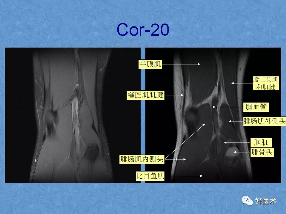 膝关节MRI高清解剖图解，值得收藏！