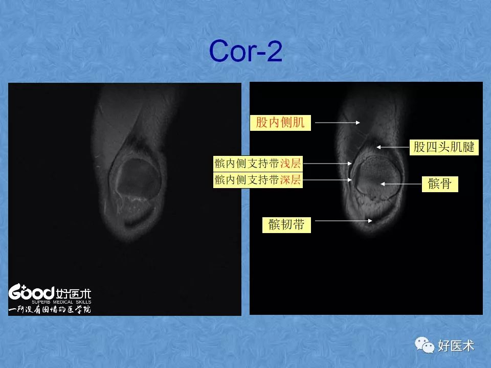 膝关节MRI高清解剖图解，值得收藏！