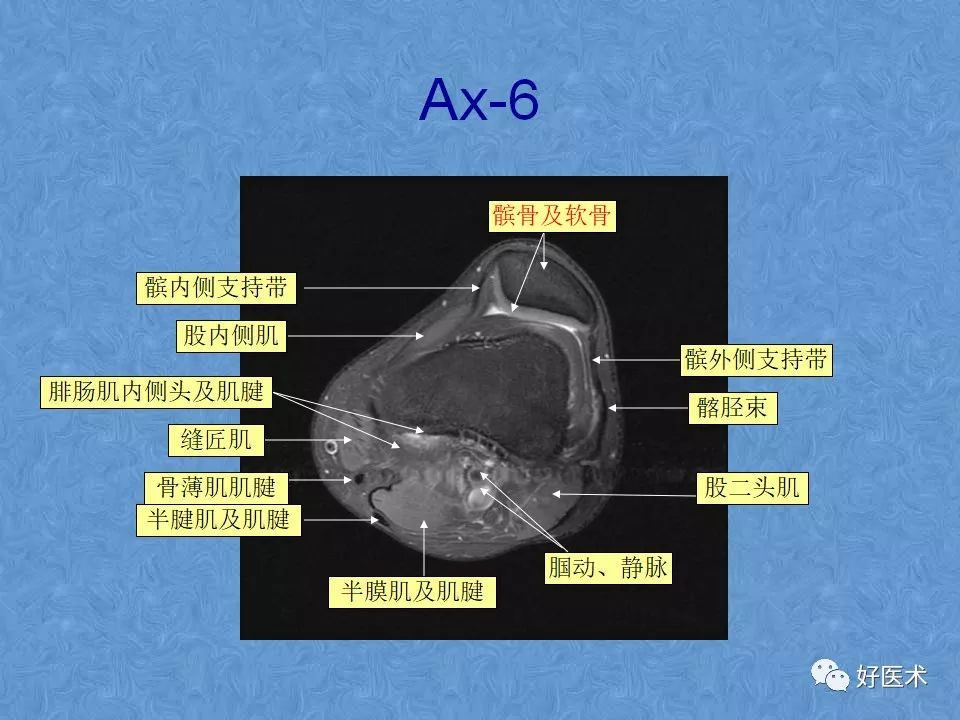 膝关节MRI高清解剖图解，值得收藏！