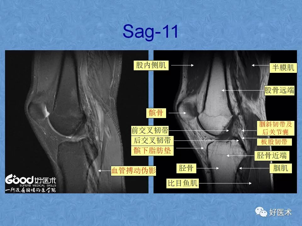 膝关节MRI高清解剖图解，值得收藏！