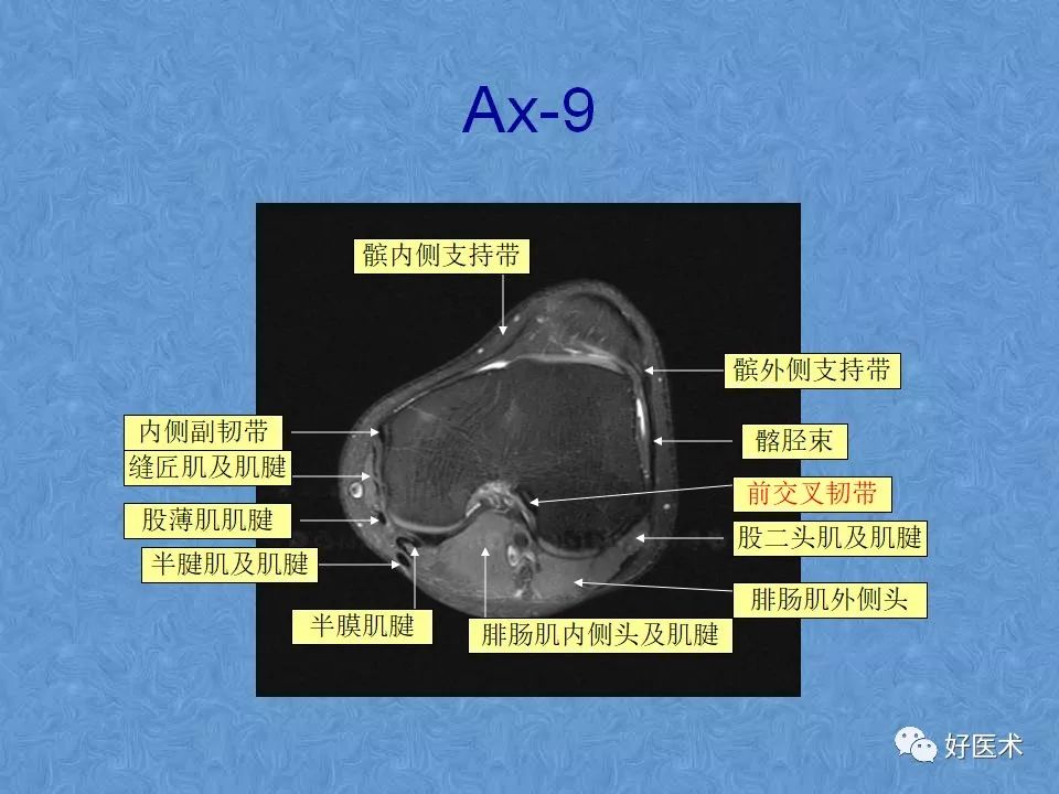 膝关节MRI高清解剖图解，值得收藏！