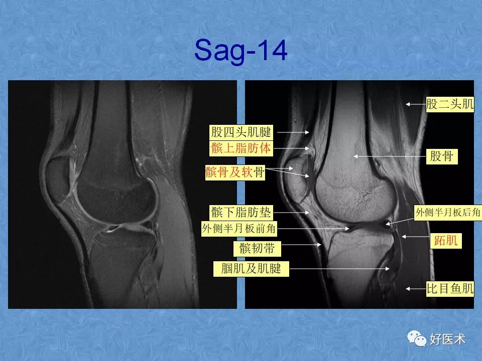 膝关节MRI高清解剖图解，值得收藏！
