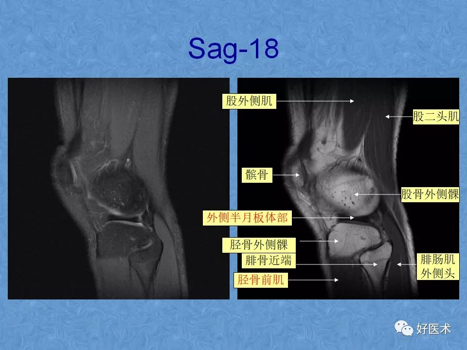 膝关节MRI高清解剖图解，值得收藏！