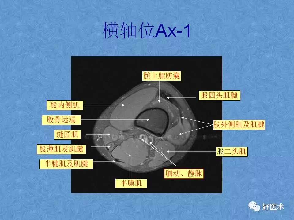 膝关节MRI高清解剖图解，值得收藏！