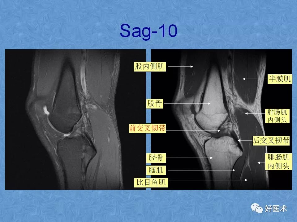 膝关节MRI高清解剖图解，值得收藏！