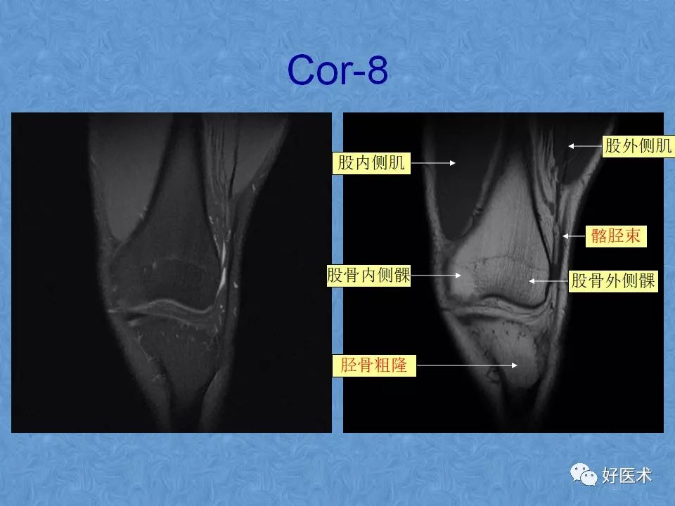 膝关节MRI高清解剖图解，值得收藏！